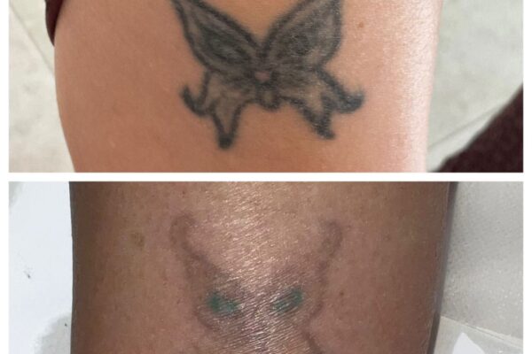 laser-tattoo-removal-treatment-7-1