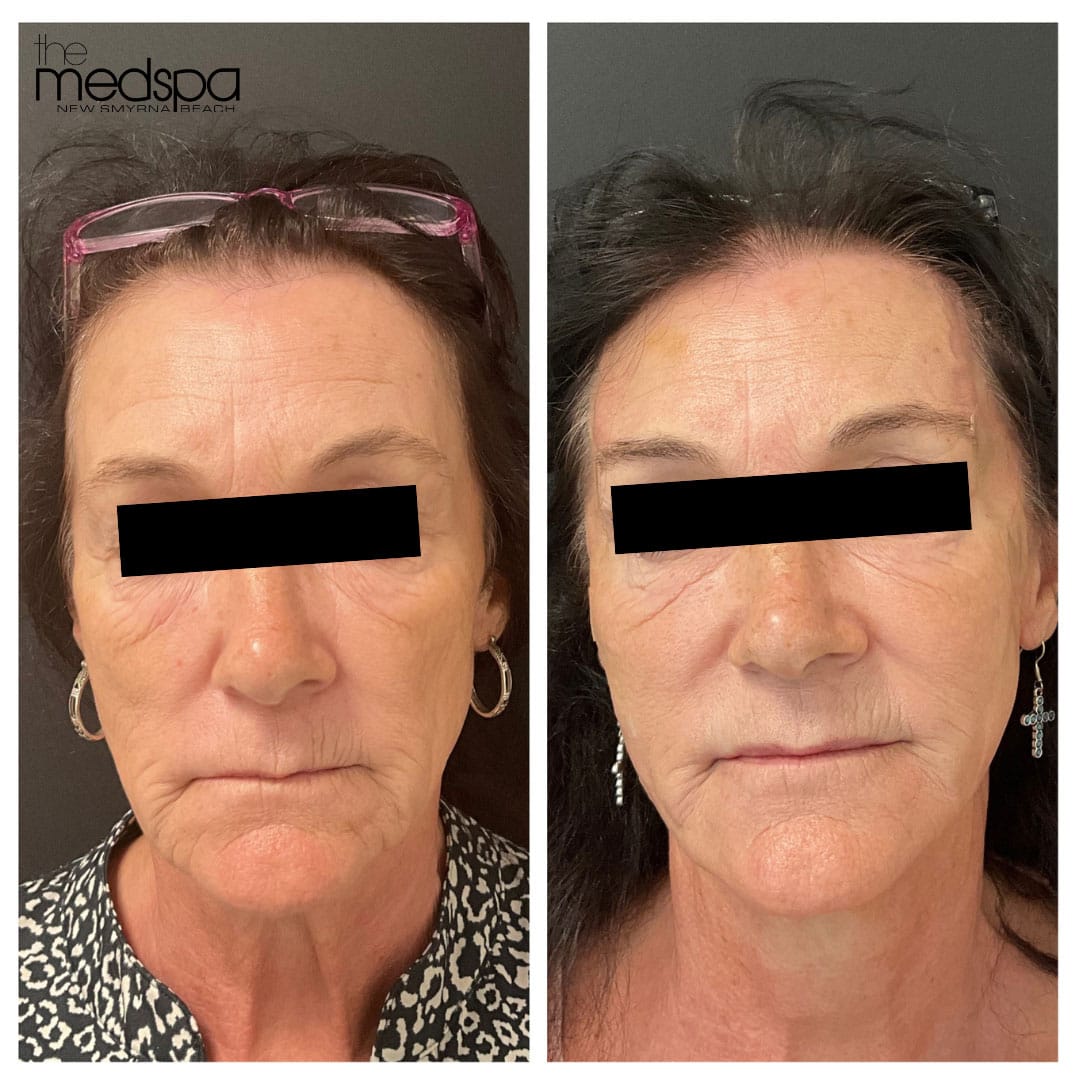 botox-filler-pdo-threads-2a